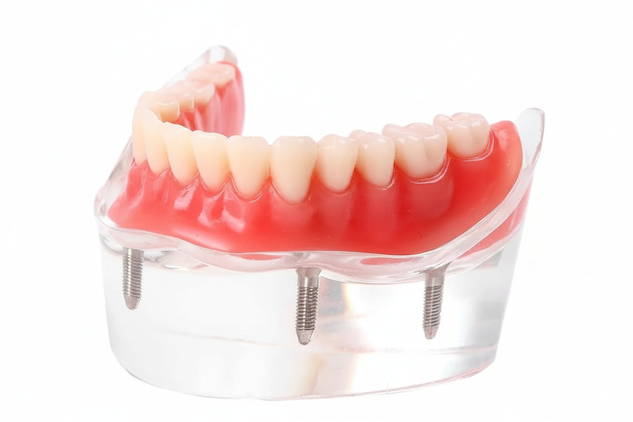 4 Implant Model 